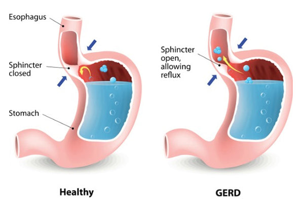 Gastroesophageal Reflux