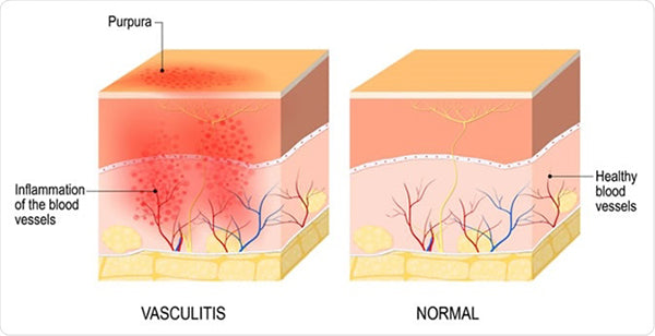 Takayasu's arteritis